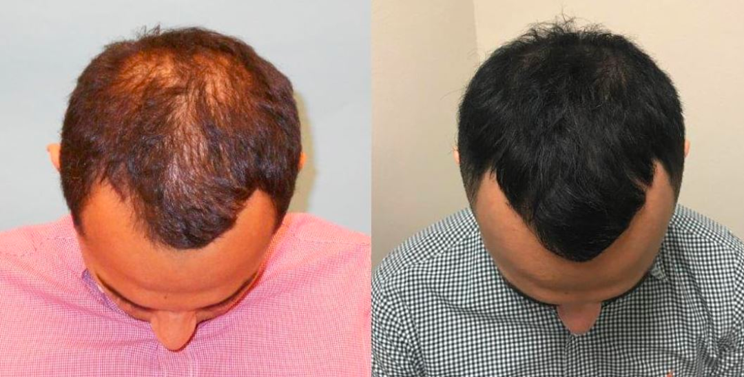 PRP before and after for hair loss