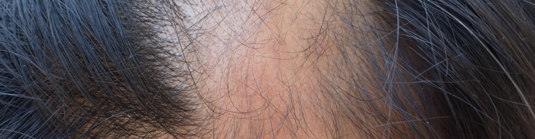 Hair Loss