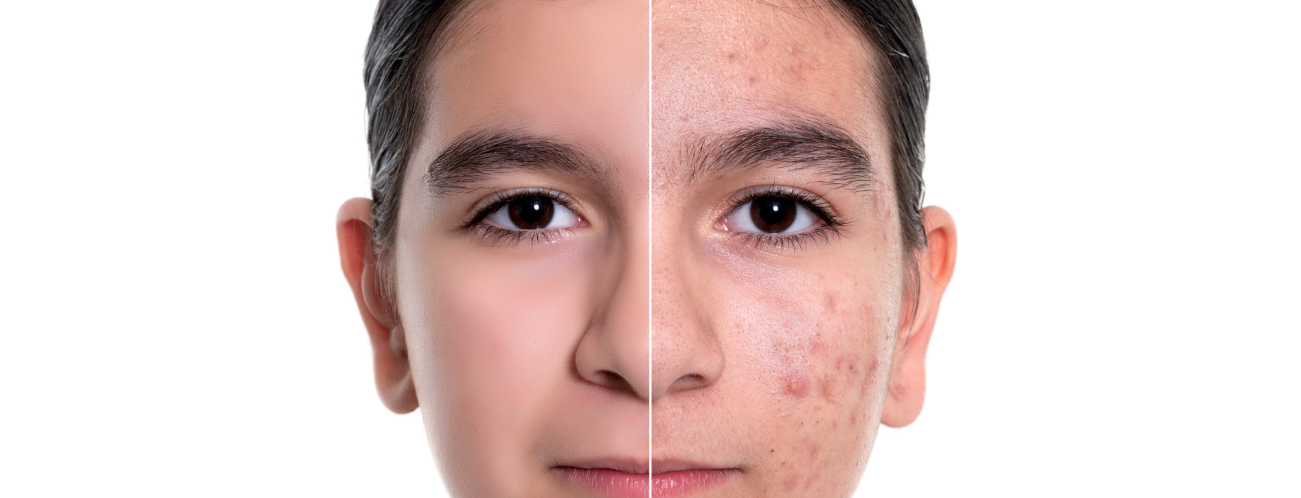 Teenage Skin: How Dermatologists Can Help Teenagers Achieve Healthy Skin - NIU ME